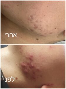טיפול באקנה בכרמיאל: שמירה על בריאות העור בדרך הנכונה