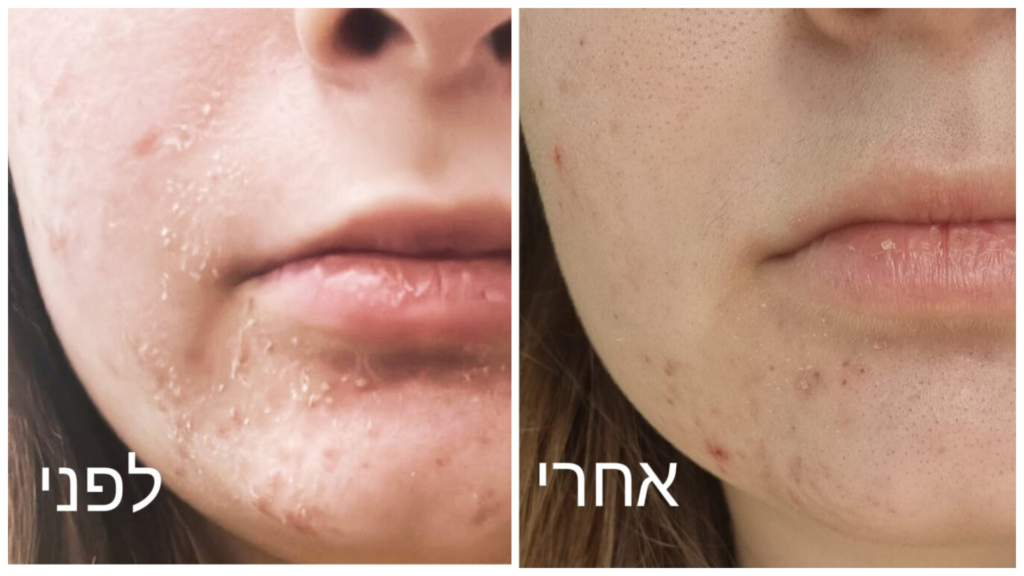 גורמים לאקנה וטיפול באקנה בכרמיאל: שמירה על בריאות העור בדרך הנכונה