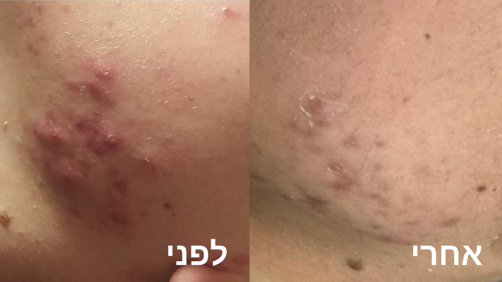 טיפול באקנה בכרמיאל שמירה על בריאות העור בדרך הנכונה