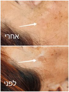 דוגמאות לתמונות לפני ואחרי הטיפול, המציגות שיפור מרשים במראה העור לאחר טיפול בפיגמנטציה.