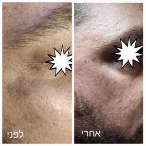 תמונת דוגמא לפני ואחרי הטיפול, המציגה שיפור מרשים במראה העור לאחר טיפול בפיגמנטציה.